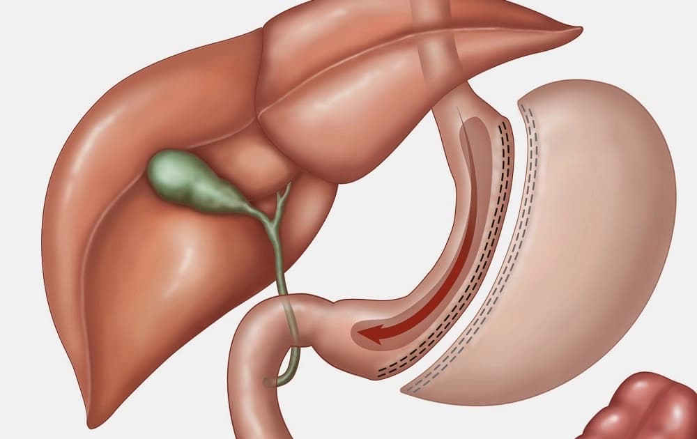 Ilustración de Manga Gástrica